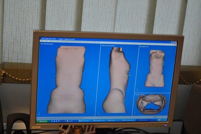 3D Scanning Stories | 3D Custom Braces for orthopedics and prosthetics